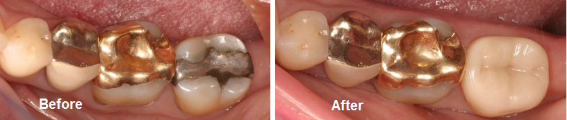 cerec before and after