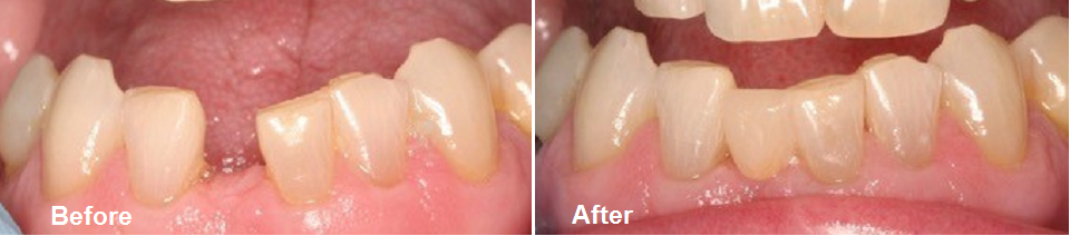 before and after bridge