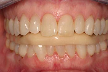 Bruxism Treatment