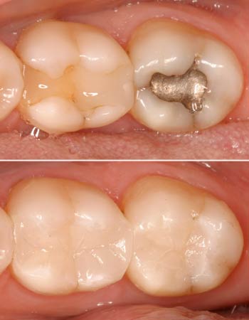 Composite Fillings