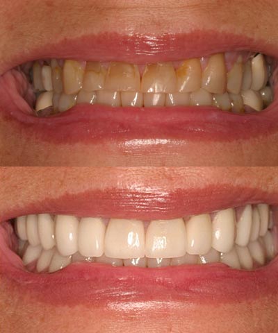 Full Mouth Dental Restoration Transforming Fairlawn Smiles