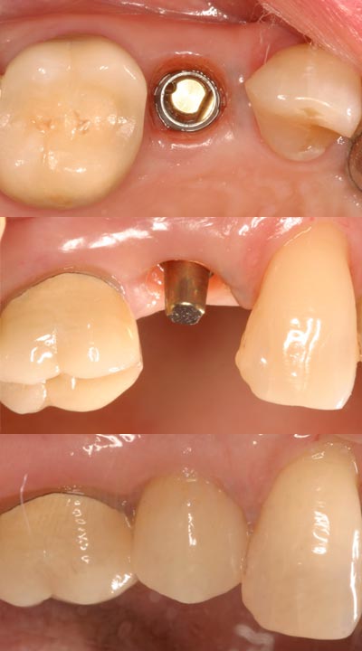 Missing Teeth? Smile Again – With Fairlawn Dental Implant Restorations