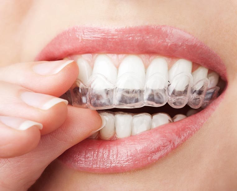 Akron Invisalign® Clear Braces Invisibly Correcting Crooked Smiles