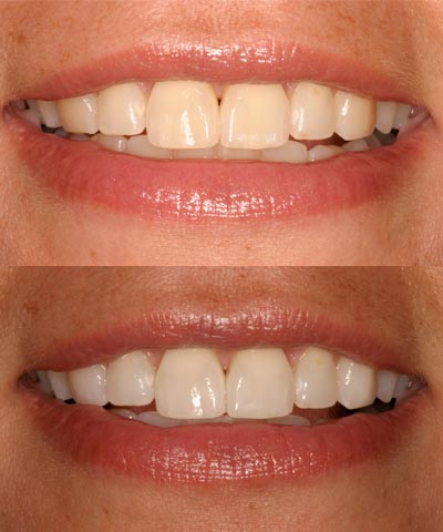 Akron’s Brightest Smiles Start with Tooth Whitening